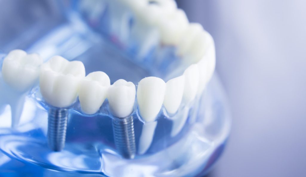 Same Day Dental Implants