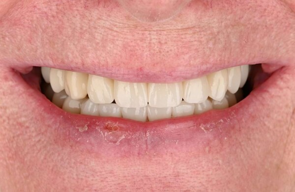 After All-on-4 implants