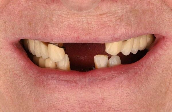 Before All-on-4 implants