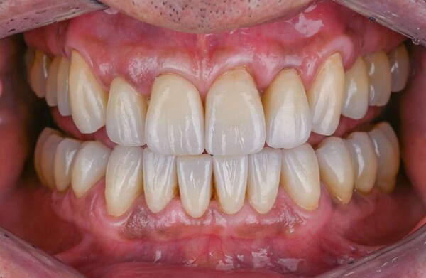After All-on-4 implants
