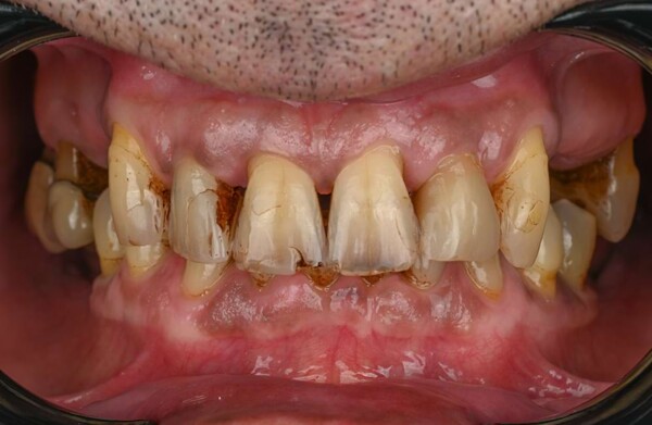 Before All-on-4 implants