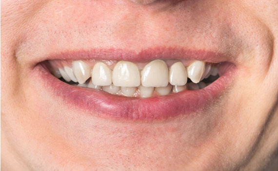 After All-on-4 implants