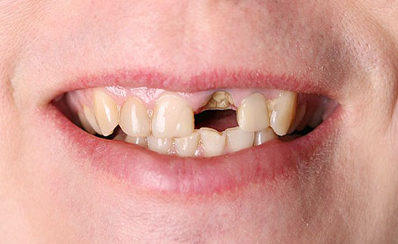 Before All-on-4 implants